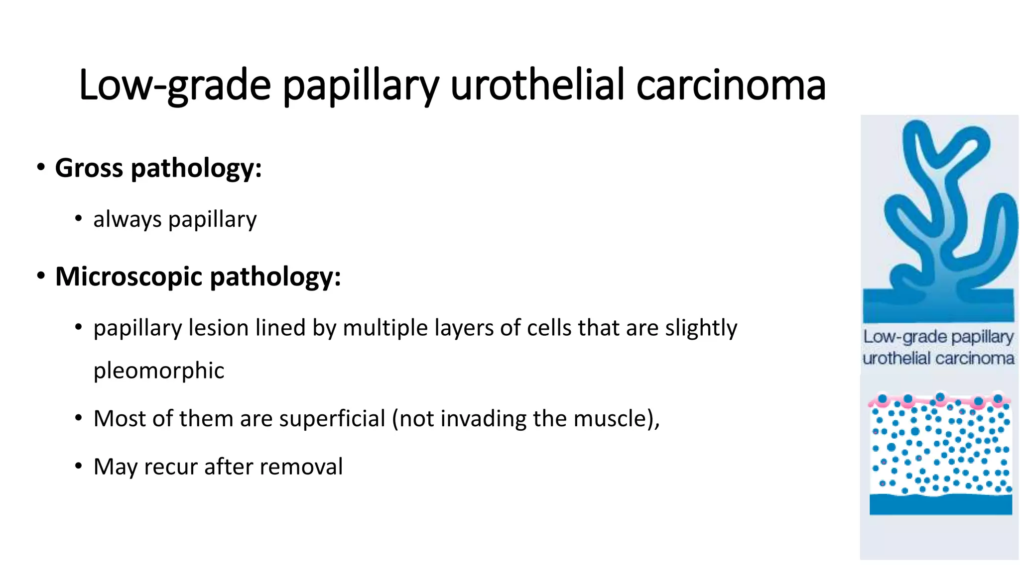Low-grade papillary urothelial carcinoma
• Gross pathology:
• always papillary
• Microscopic pathology:
• papillary lesion lined by multiple layers of cells that are slightly
pleomorphic
• Most of them are superficial (not invading the muscle),
• May recur after removal
 