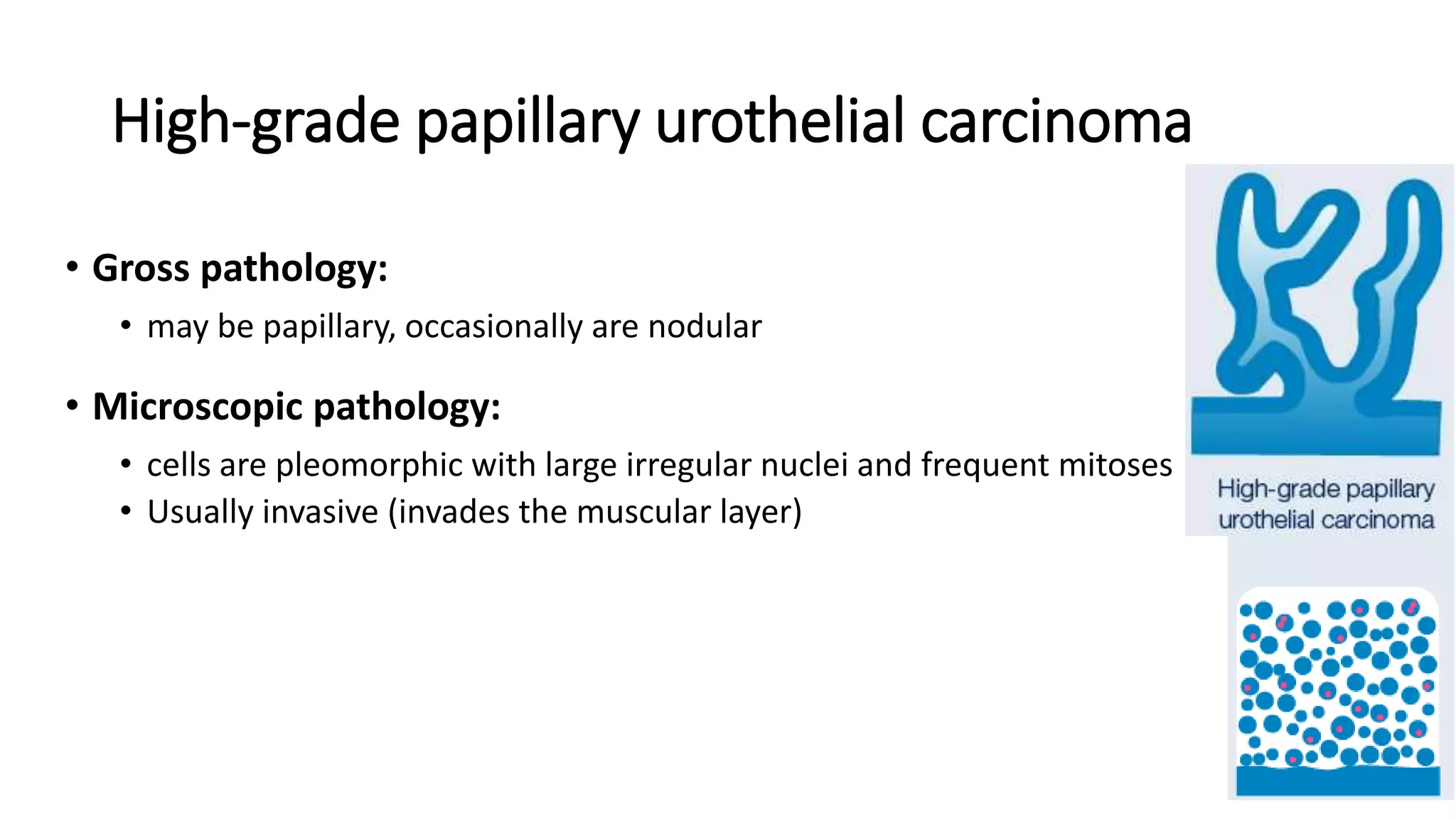 High-grade papillary urothelial carcinoma
• Gross pathology:
• may be papillary, occasionally are nodular
• Microscopic pathology:
• cells are pleomorphic with large irregular nuclei and frequent mitoses
• Usually invasive (invades the muscular layer)
 