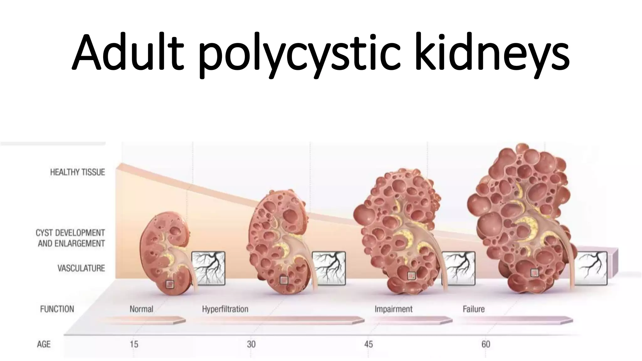 Adult polycystic kidneys
 