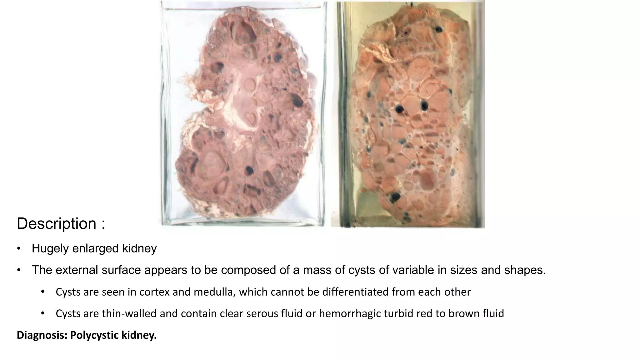 Description :
• Hugely enlarged kidney
• The external surface appears to be composed of a mass of cysts of variable in sizes and shapes.
• Cysts are seen in cortex and medulla, which cannot be differentiated from each other
• Cysts are thin-walled and contain clear serous fluid or hemorrhagic turbid red to brown fluid
Diagnosis: Polycystic kidney.
 