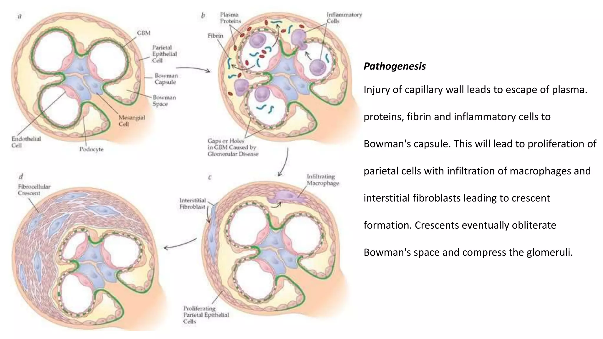 Pathogenesis
Injury of capillary wall leads to escape of plasma.
proteins, fibrin and inflammatory cells to
Bowman's capsule. This will lead to proliferation of
parietal cells with infiltration of macrophages and
interstitial fibroblasts leading to crescent
formation. Crescents eventually obliterate
Bowman's space and compress the glomeruli.
 