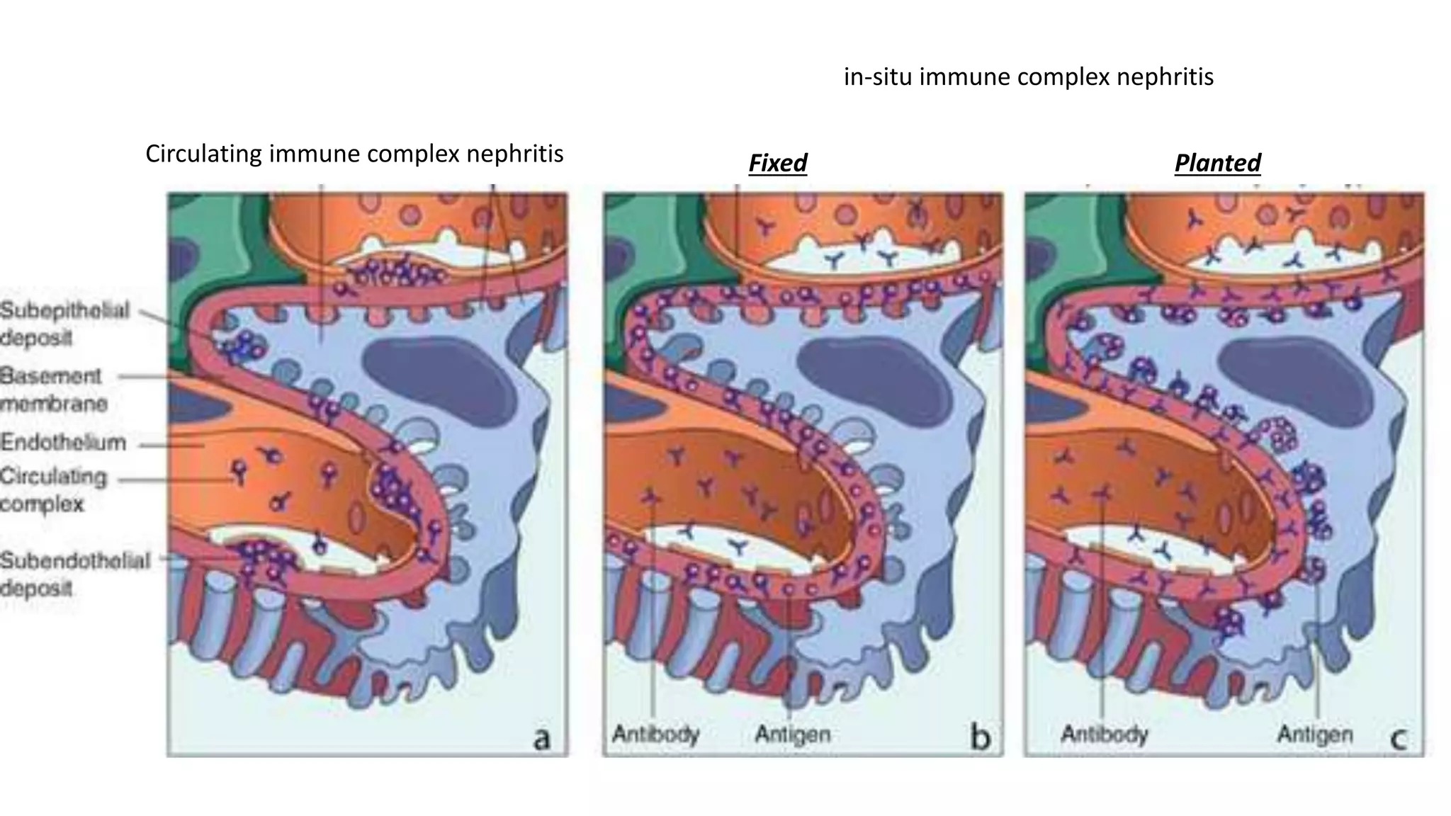 Circulating immune complex nephritis
in-situ immune complex nephritis
Fixed Planted
 