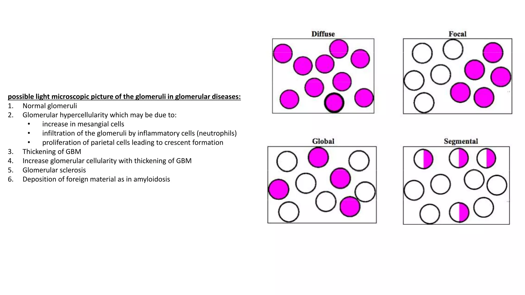possible light microscopic picture of the glomeruli in glomerular diseases:
1. Normal glomeruli
2. Glomerular hypercellularity which may be due to:
• increase in mesangial cells
• infiltration of the glomeruli by inflammatory cells (neutrophils)
• proliferation of parietal cells leading to crescent formation
3. Thickening of GBM
4. Increase glomerular cellularity with thickening of GBM
5. Glomerular sclerosis
6. Deposition of foreign material as in amyloidosis
 