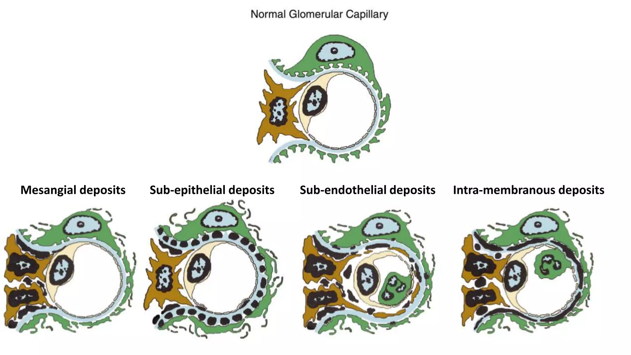 Mesangial deposits Sub-epithelial deposits Sub-endothelial deposits Intra-membranous deposits
 