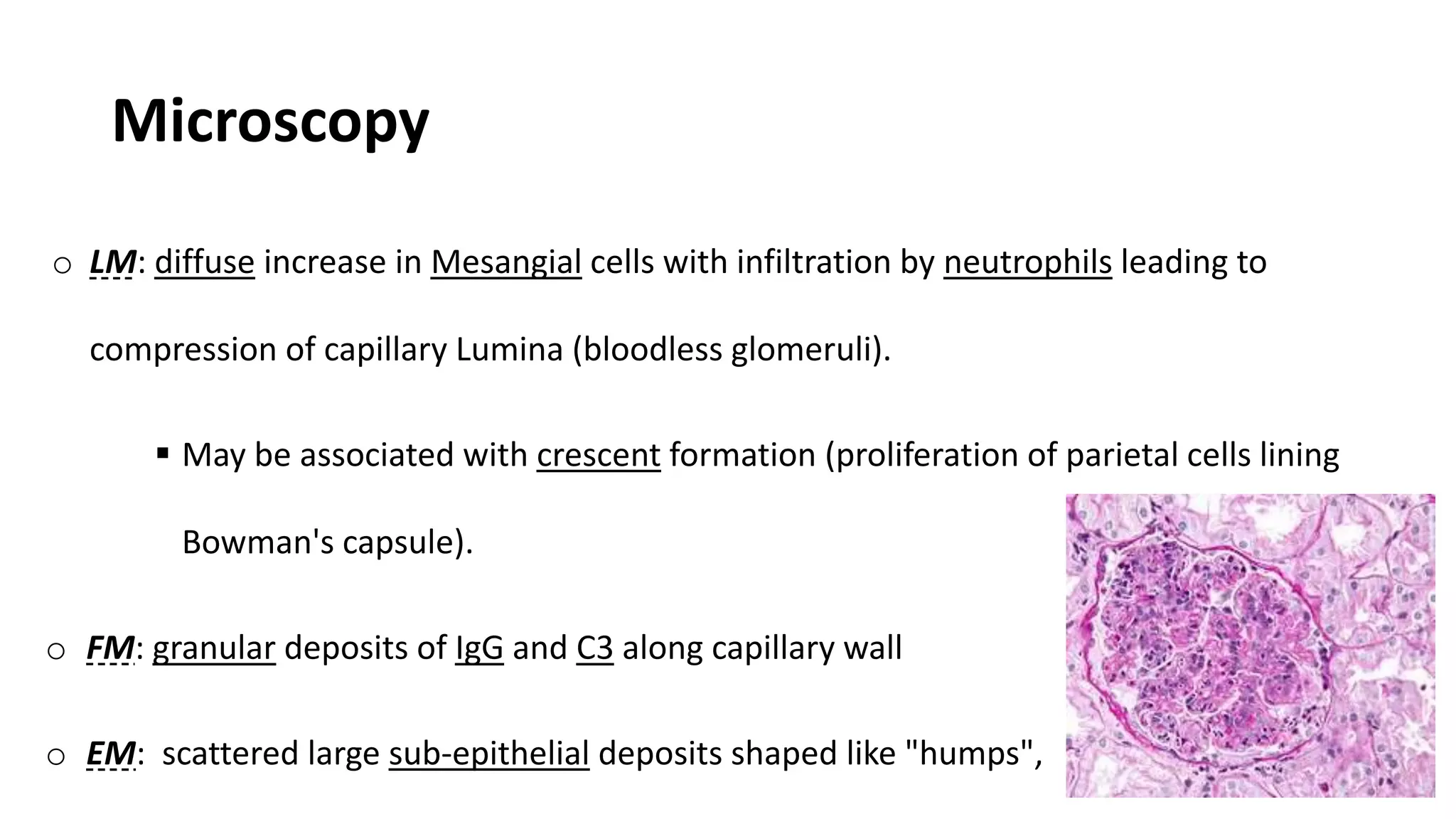 Microscopy
o LM: diffuse increase in Mesangial cells with infiltration by neutrophils leading to
compression of capillary Lumina (bloodless glomeruli).
 May be associated with crescent formation (proliferation of parietal cells lining
Bowman's capsule).
o FM: granular deposits of IgG and C3 along capillary wall
o EM: scattered large sub-epithelial deposits shaped like "humps",
 