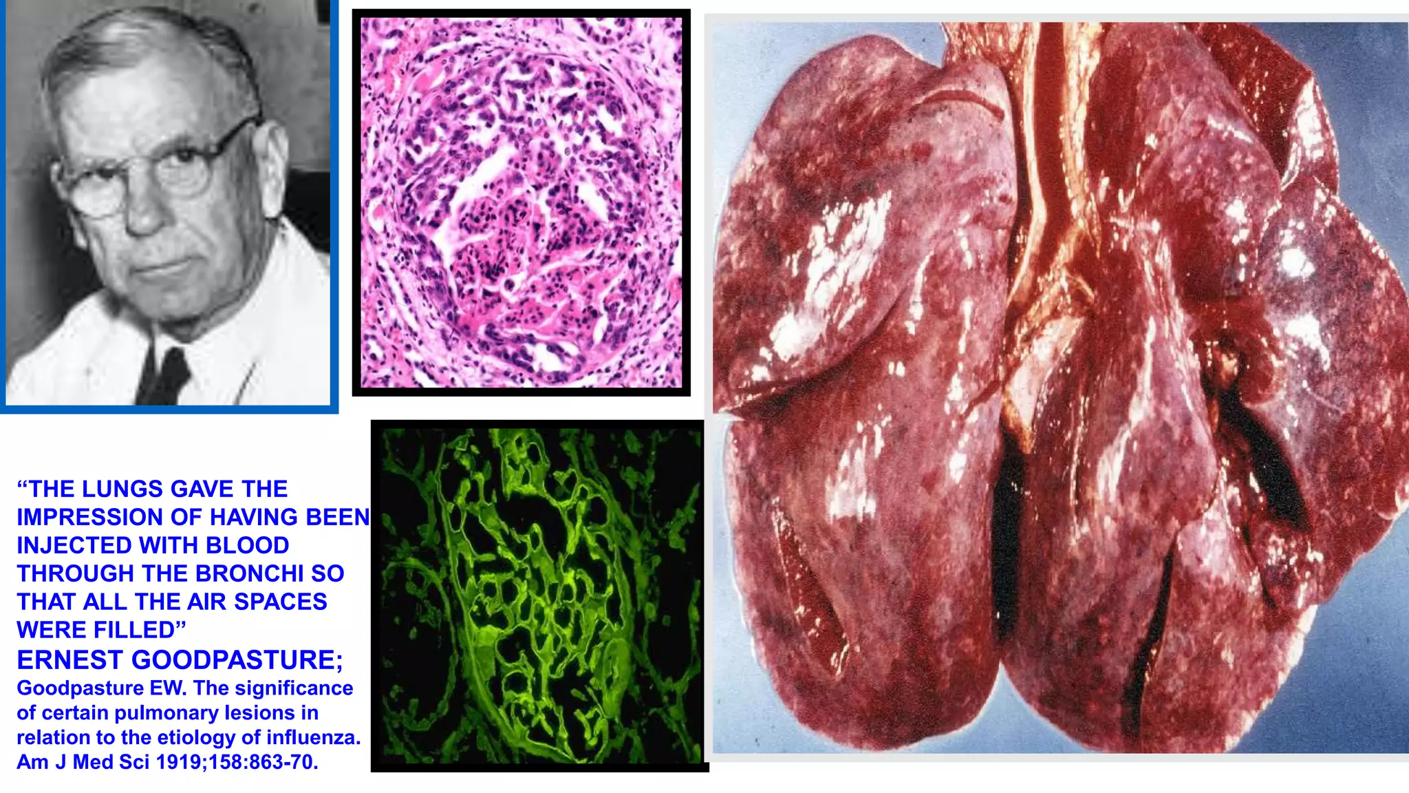 “THE LUNGS GAVE THE
IMPRESSION OF HAVING BEEN
INJECTED WITH BLOOD
THROUGH THE BRONCHI SO
THAT ALL THE AIR SPACES
WERE FILLED”
ERNEST GOODPASTURE;
Goodpasture EW. The significance
of certain pulmonary lesions in
relation to the etiology of influenza.
Am J Med Sci 1919;158:863-70.
 