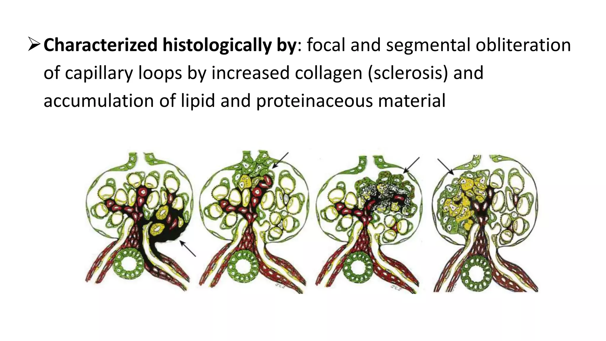Characterized histologically by: focal and segmental obliteration
of capillary loops by increased collagen (sclerosis) and
accumulation of lipid and proteinaceous material
 