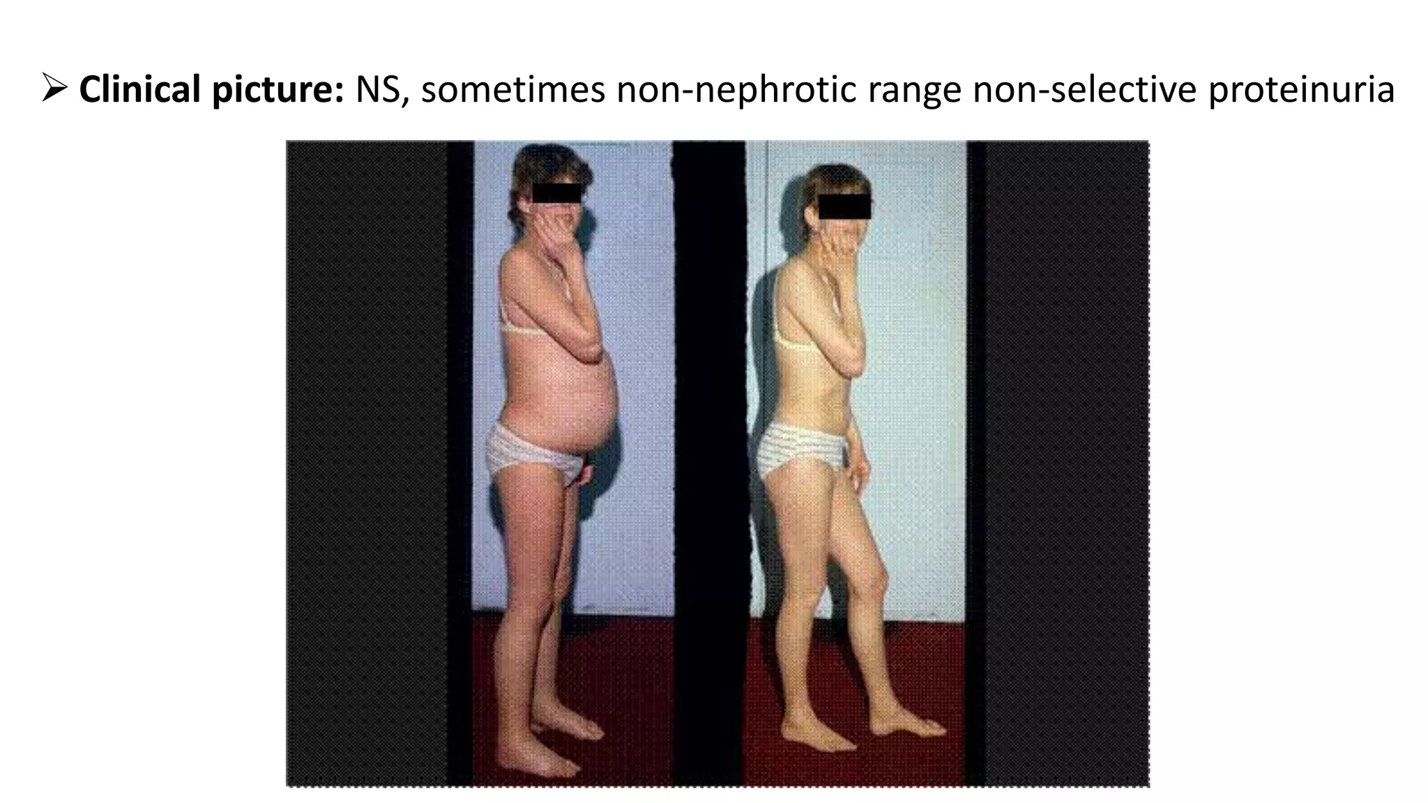  Clinical picture: NS, sometimes non-nephrotic range non-selective proteinuria
 
