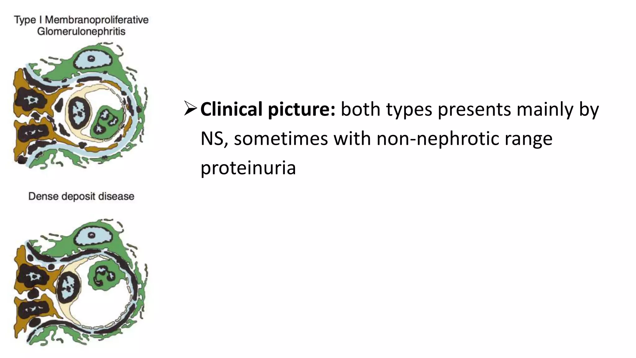 Clinical picture: both types presents mainly by
NS, sometimes with non-nephrotic range
proteinuria
 