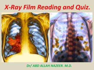X-Ray Film Reading and Quiz.
Dr/ ABD ALLAH NAZEER. M.D.
 
