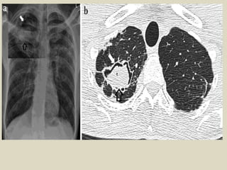 PA and lateral of hiatal hernia. Can you see
the air-filled "mass" posterior to the heart?
 