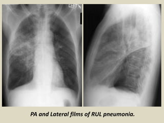 Upper lobe round pneumonia with resolution on follow-up study.
 