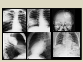 Presentation1, x ray film reading of the chest.