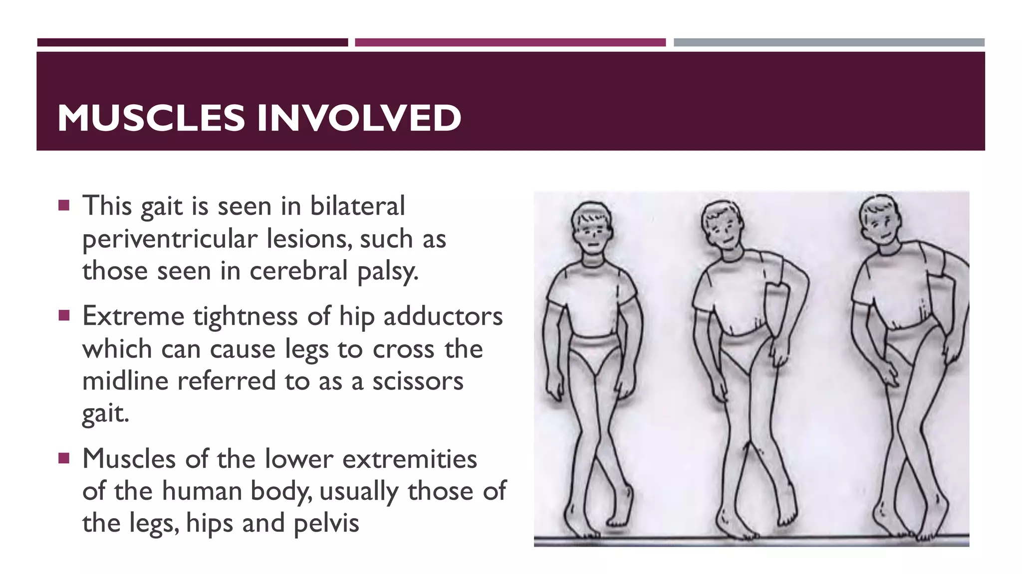 MUSCLES INVOLVED
 This gait is seen in bilateral
periventricular lesions, such as
those seen in cerebral palsy.
 Extreme tightness of hip adductors
which can cause legs to cross the
midline referred to as a scissors
gait.
 Muscles of the lower extremities
of the human body, usually those of
the legs, hips and pelvis
 