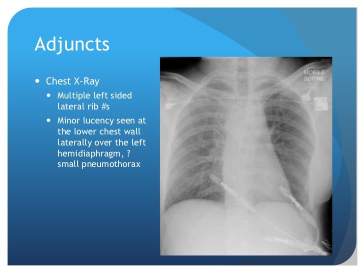 Seatbelt Injury Trauma Presentation
