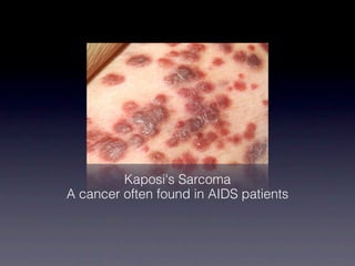 Kaposi's Sarcoma
A cancer often found in AIDS patients
 