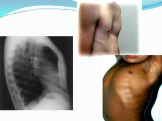 Investigations,
 BASIC INVESTIGATIONS TO CONFIRM RICKETS


 Serum Ca, P and SAP
 X rays of ends of long bones at knees ...