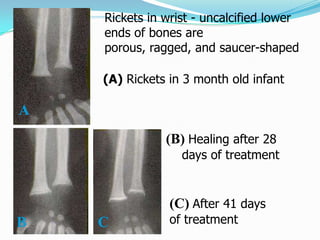 Rickets in wrist - uncalcified lower
    ends of bones are
    porous, ragged, and saucer-shaped

    (A) Rickets in 3 month old infant

A
               (B) Healing after 28
                  days of treatment


                (C) After 41 days
B   C           of treatment
 