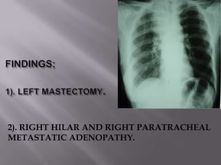2). RIGHT HILAR AND RIGHT PARATRACHEAL
METASTATIC ADENOPATHY.
 