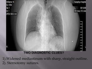 1).Widened mediastinum with sharp, straight outline.
2). Sternotomy sutures.
 