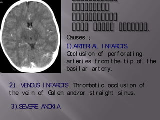Causes ;
                    1).AR I AL I N C
                          TER          FAR TS.
                    O usi on of per f or at i ng
                     ccl
                    ar t er i es f r om t he t i p of t he
                    basi l ar ar t er y.

2). VEN U I N C
        O S FAR TS. Thr om i c occl usi on of
                          bot
t he vei n of G en and/or st r ai ght si nus.
               al

3).SEVER AN XI A.
        E O
 