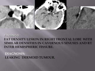 DIAGNOSIS;
LEAKING DERMOID TUMOUR.
 