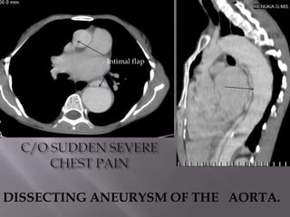 Intimal flap




DISSECTING ANEURYSM OF THE AORTA.
 