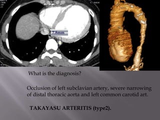 7.8mm




What is the diagnosis?

Occlusion of left subclavian artery, severe narrowing
of distal thoracic aorta and left common carotid art.

 TAKAYASU ARTERITIS (type2).
 