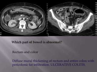 Rectum and colon.

Diffuse mural thickening of rectum and entire colon with
pericolonic fat infiltration. ULCERATIVE COLITIS.
 