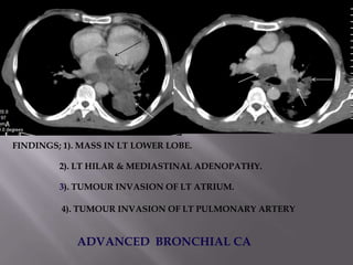 FINDINGS; 1). MASS IN LT LOWER LOBE.

         2). LT HILAR & MEDIASTINAL ADENOPATHY.

         3). TUMOUR INVASION OF LT ATRIUM.

         4). TUMOUR INVASION OF LT PULMONARY ARTERY


            ADVANCED BRONCHIAL CA
 