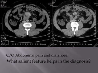 C/O Abdominal pain and diarrhoea.
What salient feature helps in the diagnosis?
 