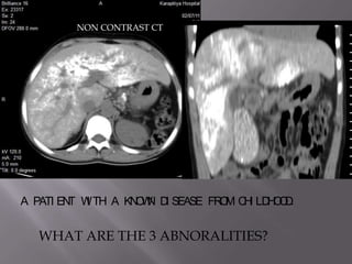 NON CONTRAST CT




         T I       ON I         O H HO.
A PATI EN W TH A KN W D SEASE FR M C I LD O D


  WHAT ARE THE 3 ABNORALITIES?
 