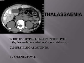 1). DIFFUSE HYPER DENSITY IN THE LIVER.
   (2ry haemachromatosis/transfusional siderosis).

2).MULTIPLE GALLSTONES.


3). SPLENECTOMY.
 