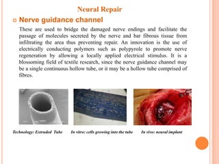 Neural Repair
 Nerve guidance channel
   These are used to bridge the damaged nerve endings and facilitate the
   passage of molecules secreted by the nerve and bar fibrous tissue from
   infiltrating the area thus preventing repair. An innovation is the use of
   electrically conducting polymers such as polypyrole to promote nerve
   regeneration by allowing a locally applied electrical stimulus. It is a
   blossoming field of textile research, since the nerve guidance channel may
   be a single continuous hollow tube, or it may be a hollow tube comprised of
   fibres.




Technology: Extruded Tube   In vitro: cells growing into the tube   In vivo: neural implant
 