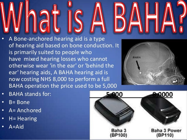 My baha hearing aid slideshow My baha hearing aid slideshow