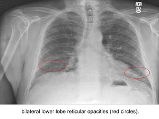 bilateral lower lobe reticular opacities (red circles).

 