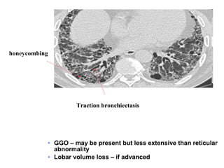 honeycombing

Traction bronchiectasis

GGO – may be present but less extensive than reticular
abnormality
Lobar volume loss – if advanced

 