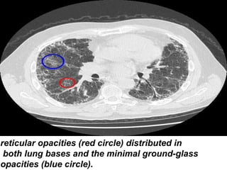 reticular opacities (red circle) distributed in
both lung bases and the minimal ground-glass
opacities (blue circle).

 