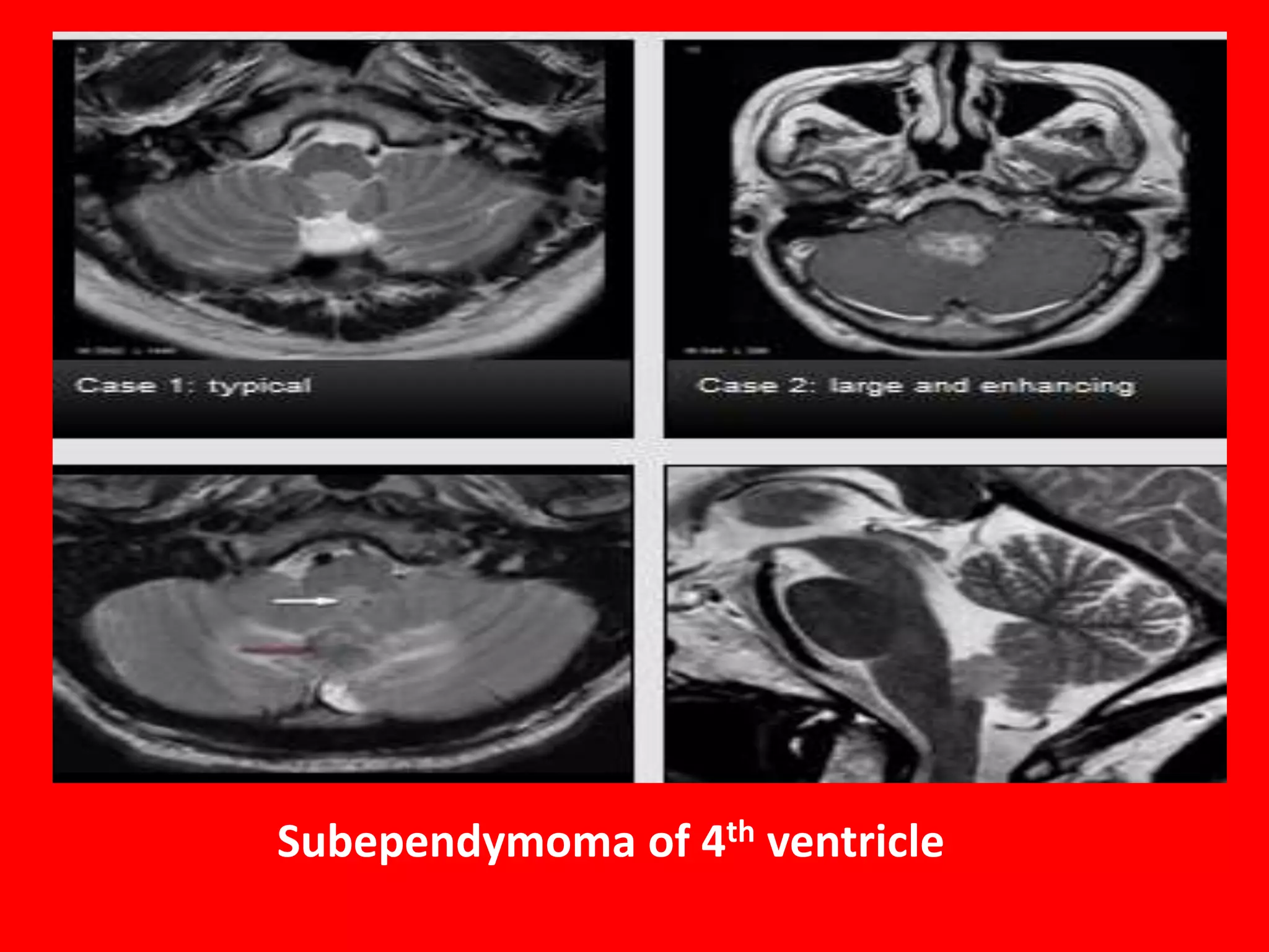 Subependymoma of 4th ventricle

 