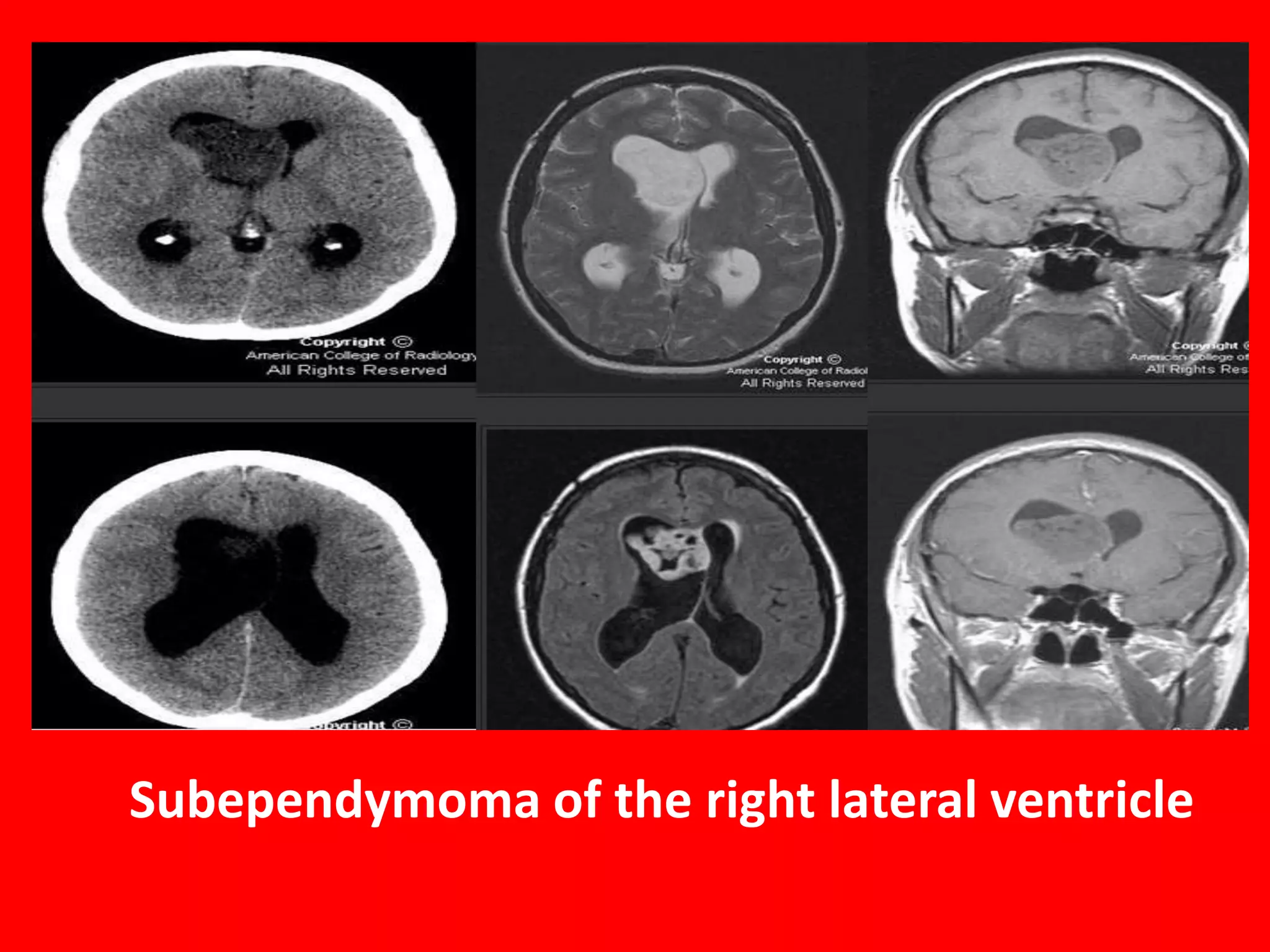 Subependymoma of the right lateral ventricle

 