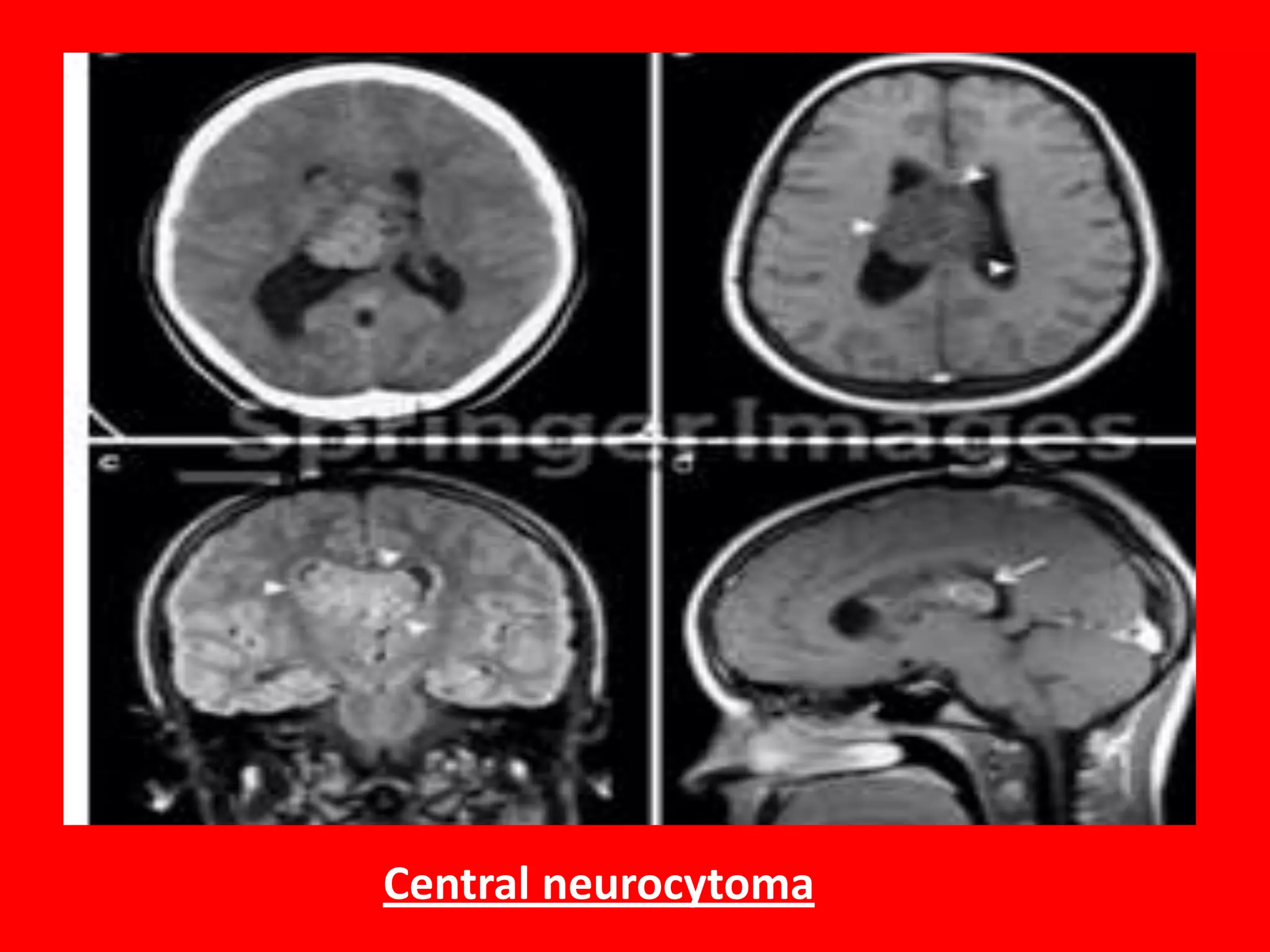 Central neurocytoma

 