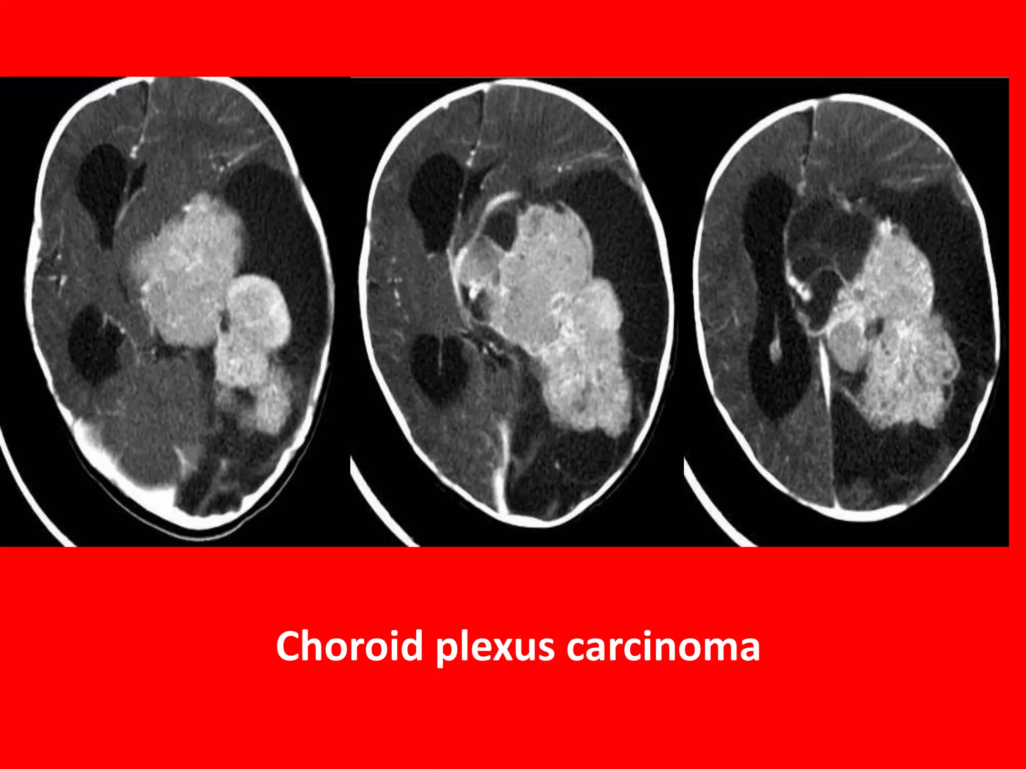 Choroid plexus carcinoma

 