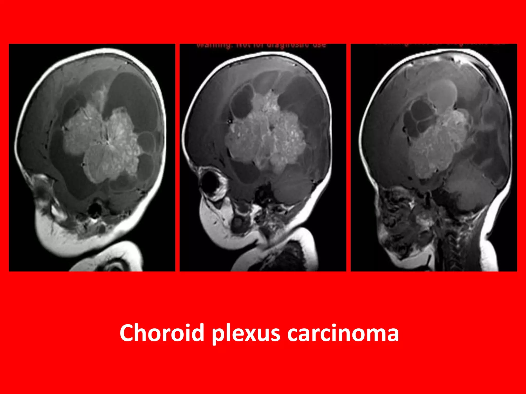 Choroid plexus carcinoma

 