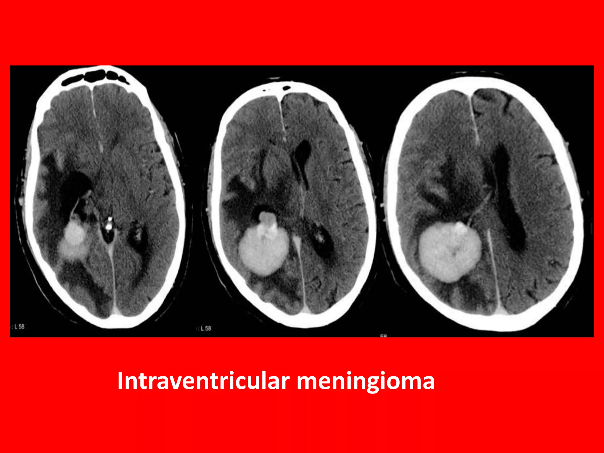 Intraventricular meningioma

 