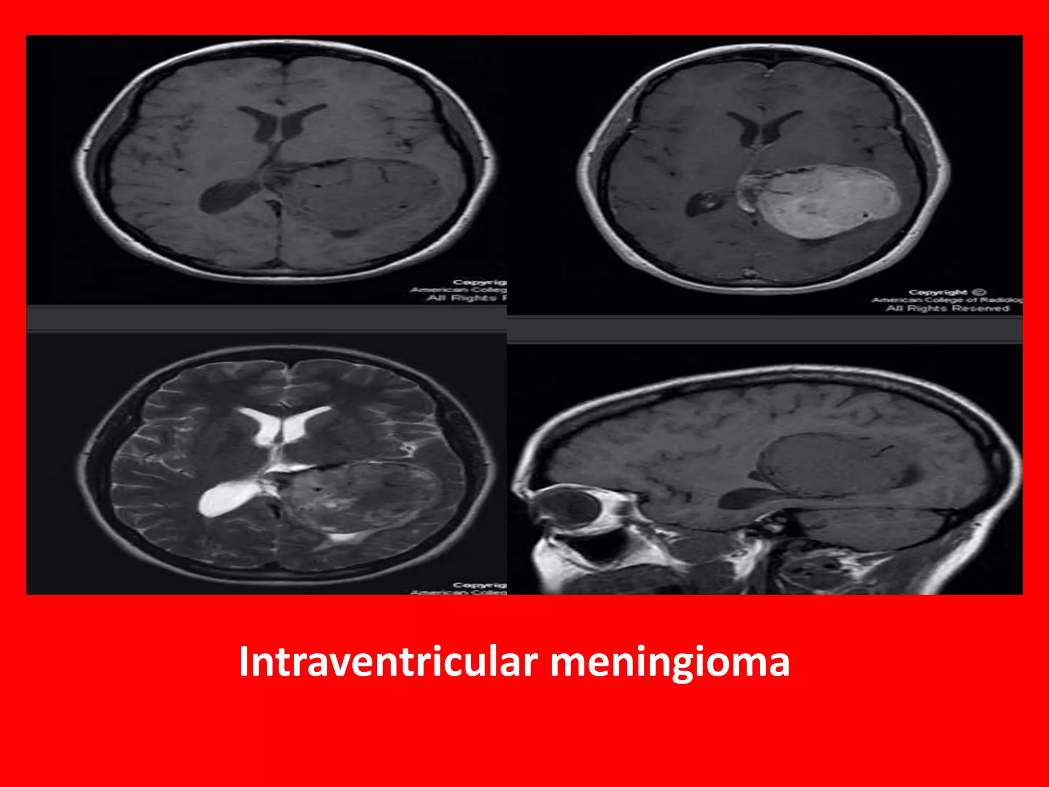 Intraventricular meningioma

 