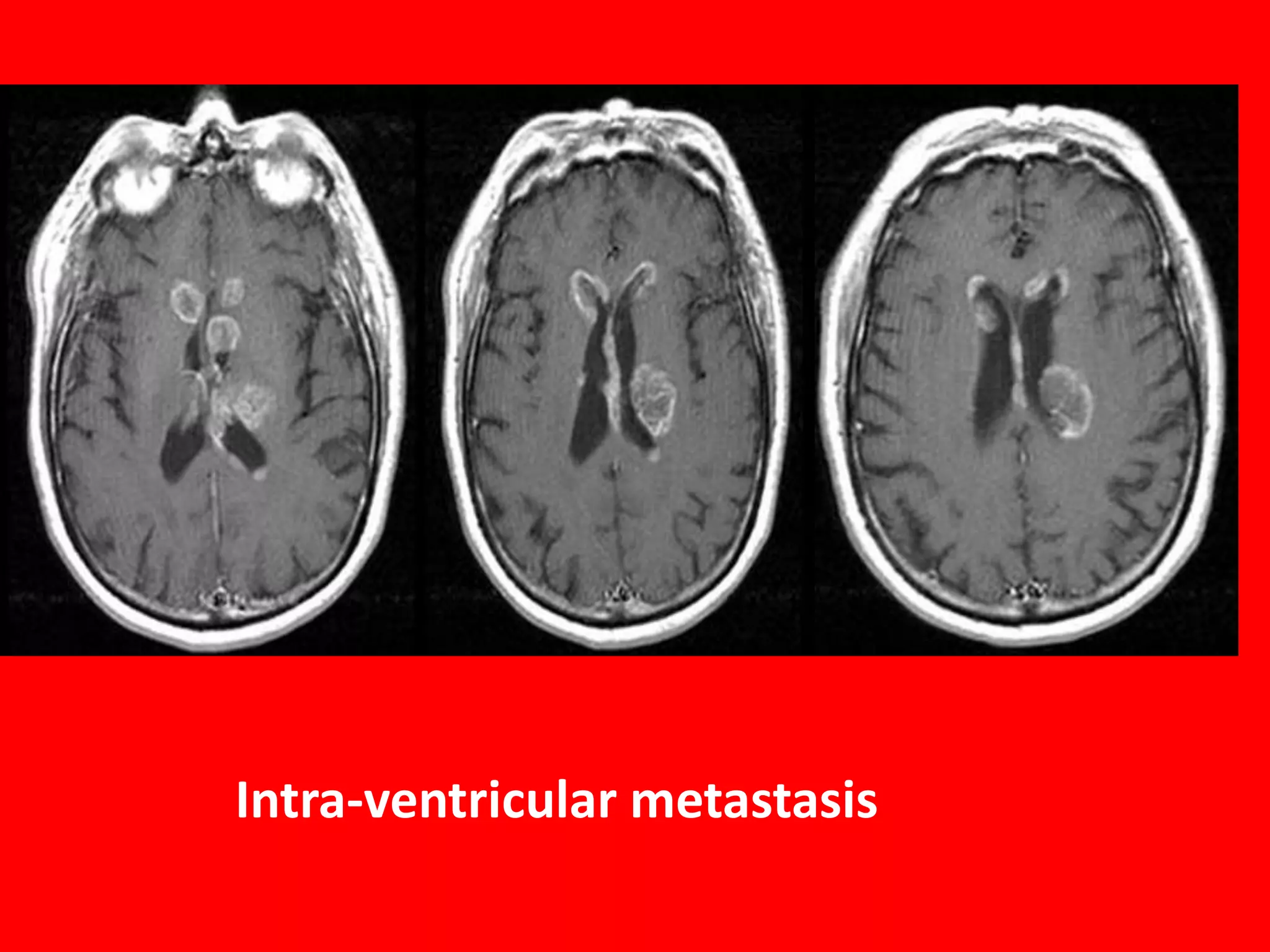 Intra-ventricular metastasis

 