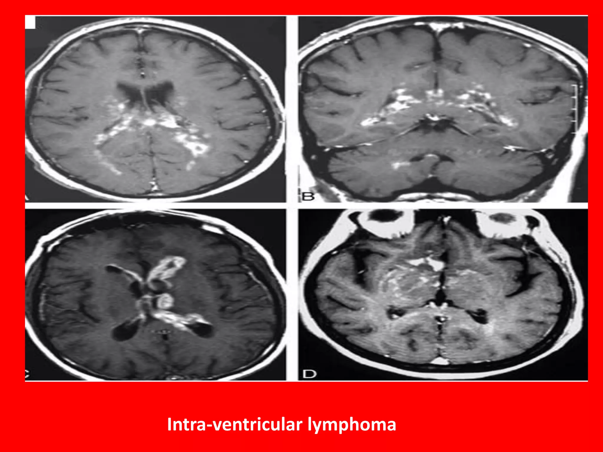 Intra-ventricular lymphoma

 