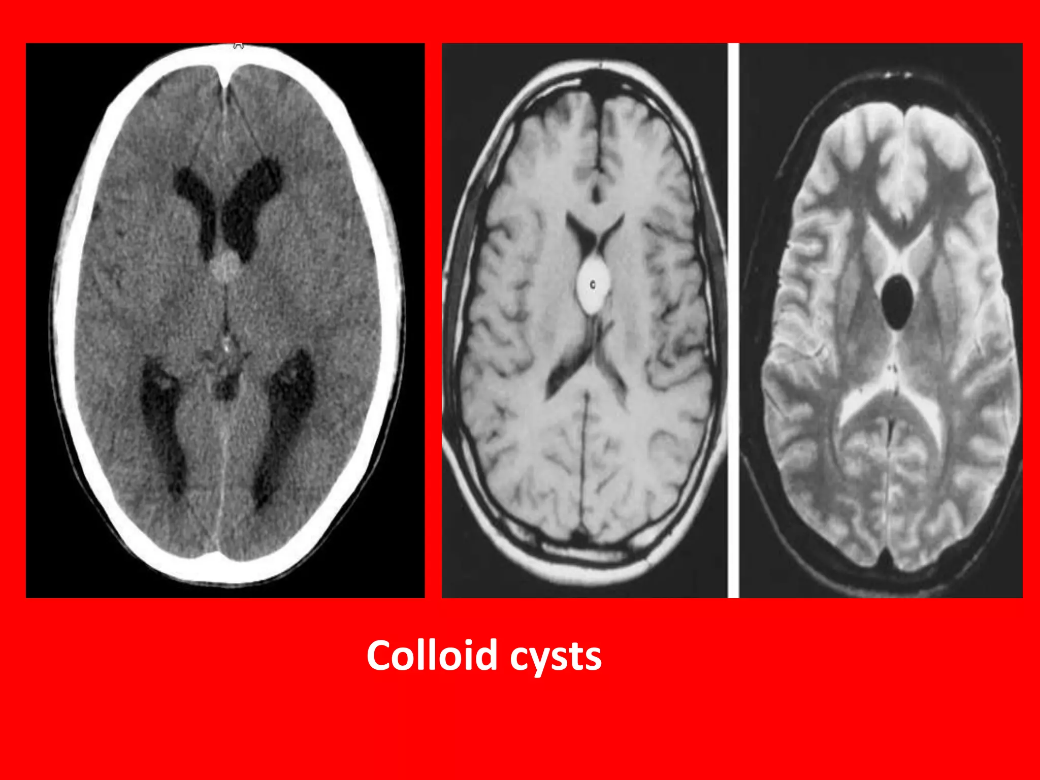 Colloid cysts

 