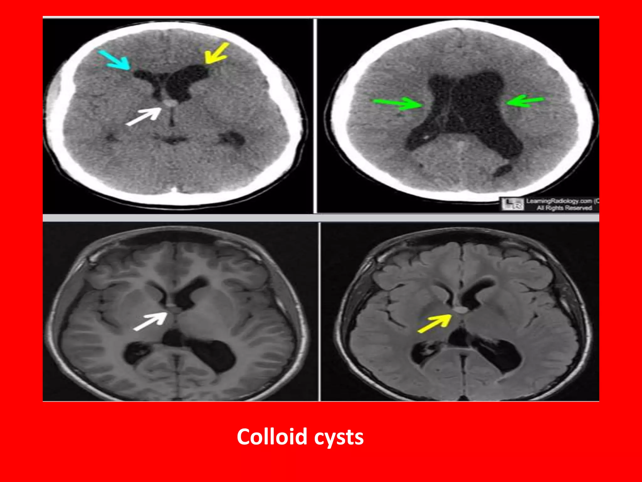 Colloid cysts

 