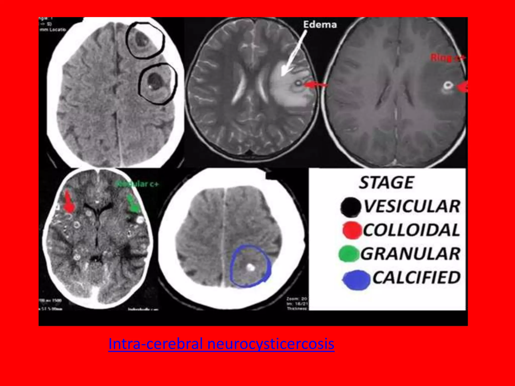 Intra-cerebral neurocysticercosis

 
